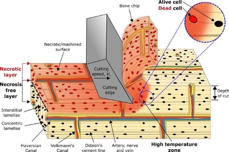 Materials & Design, Volume 197, Machining-induced thermal damage in cortical bone Necrosis and micro-mechanical integrity